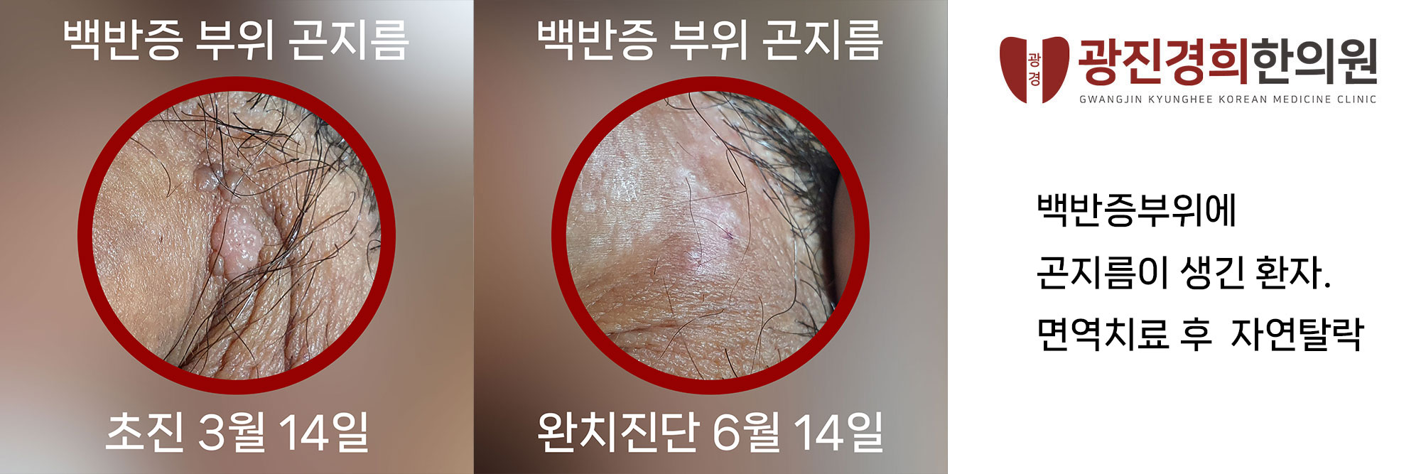 광진경희한의원 | 서울곤지름병원