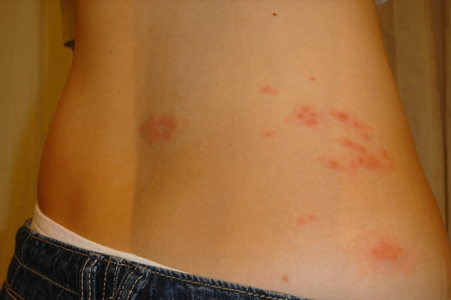 광진구대상포진병원