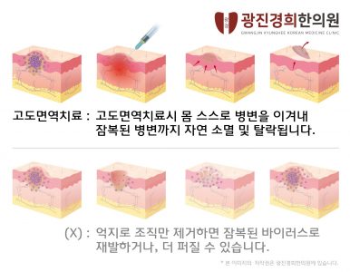 사마귀곤지름봉약침